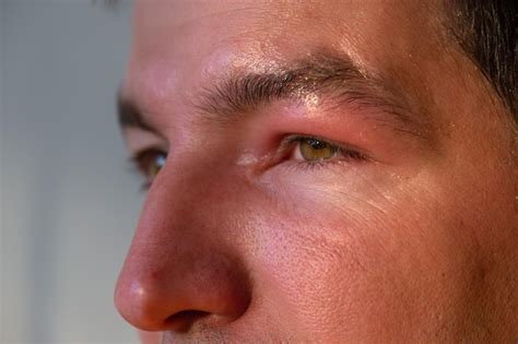 Premium Photo | A red swollen eyelid on a man's face in closeup is an allergy to an insect bite ...