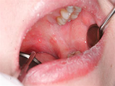 Multiple Superficial Mucoceles on Lower Lip, Soft Palate, Retromolar