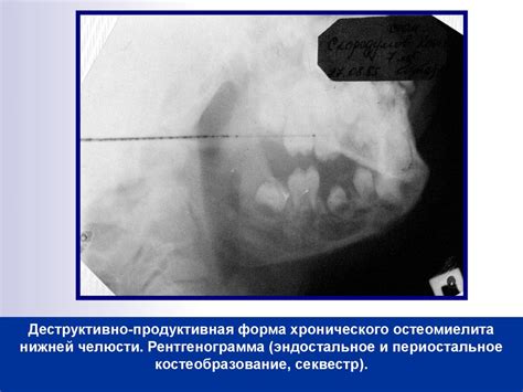 Одонтогенный остеомиелит челюстных костей у детей - презентация онлайн