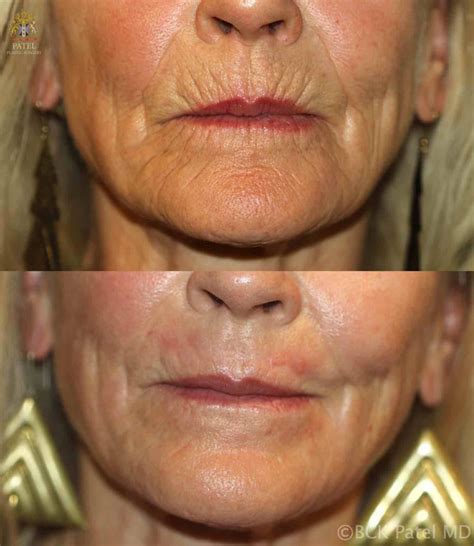 Botox Vertical Lip Lines Before After - Infoupdate.org