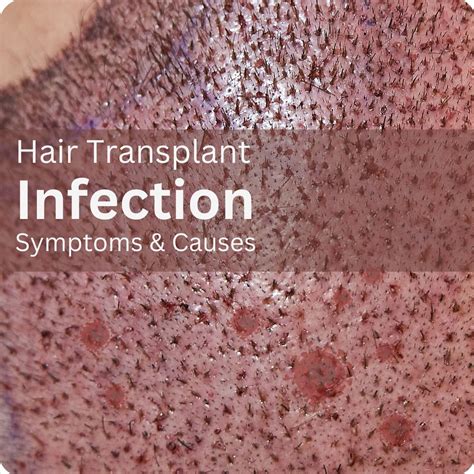 Hair Transplant Infection Symptoms & Causes - Imperium Hair Transplant ...