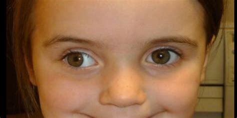 Squint Eye Treatment in Ophthalmology | by Sanika Pandit | Medium