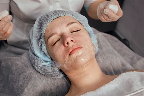 Revitalize Your Skin with Professional Chemical Peels by CosMedic LaserMd