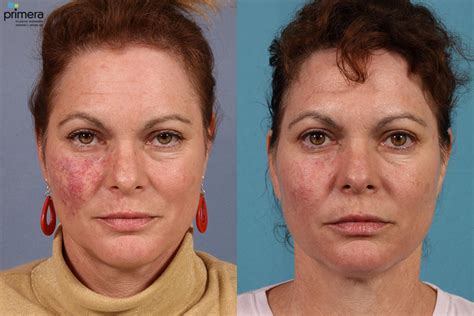 laser treatment on face before and after 4
