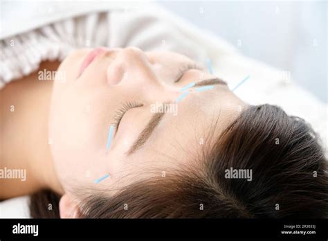 woman  acupuncture   face   acupuncture clinic