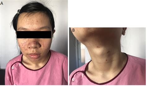 tsc mutation   patient  tuberous sclerosis complex
