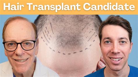 How to Pick the Perfect Candidate for a Hair Transplant - YouTube