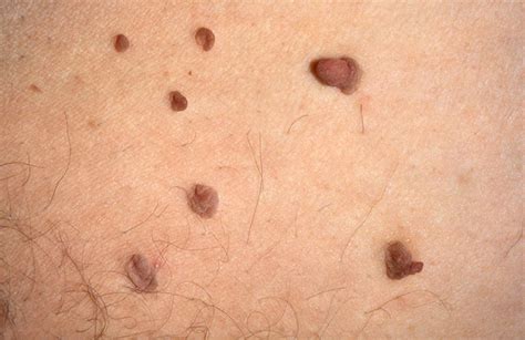 Skin tags – causes, symptoms, and removal | healthdirect