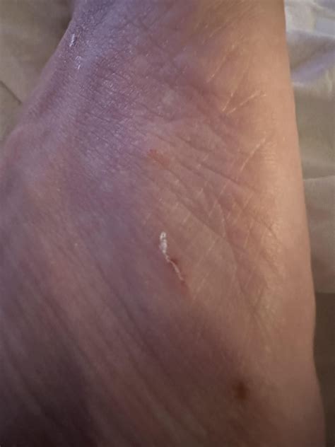 New burrow day after treatment : r/scabies