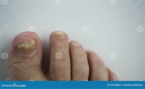 Unghie Del Piede Con Micosi Stock Footage - Video di dermatologico ...