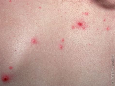 What Does Chickenpox Look Like? Signs and Images - GoodRx