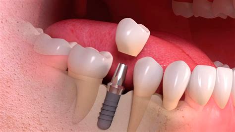 O Que Substitui Um Implante Dentário - Quando é necessário substituir um implante dentário? - Villaça Odontologia
