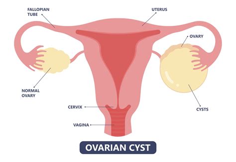 How To Treat Ovarian Cysts | Rosh MFM