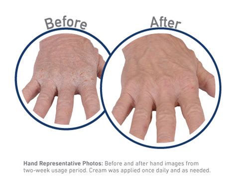 CeraVe products love or hate? : r/eczema