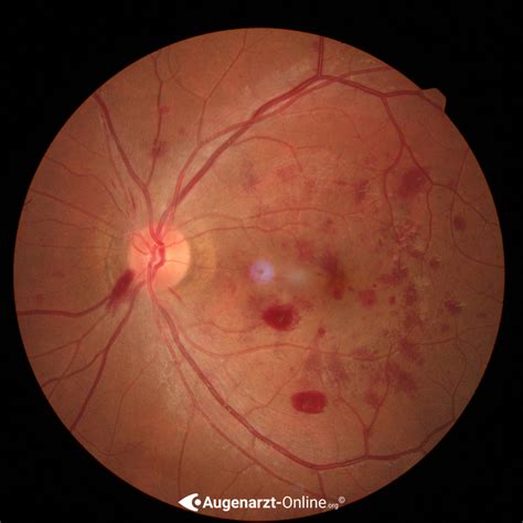 Fundus Hypertonicus | Atlas der Augenheilkunde