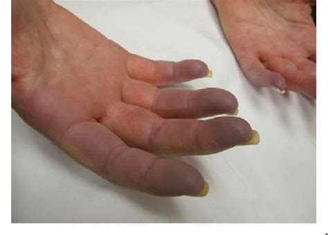 Cyanotic Skin Color