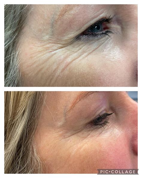 Botulinum Toxin (Botox)