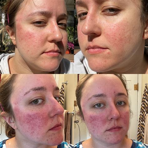 102 best r/histamineintolerance images on Pholder | Physiology of