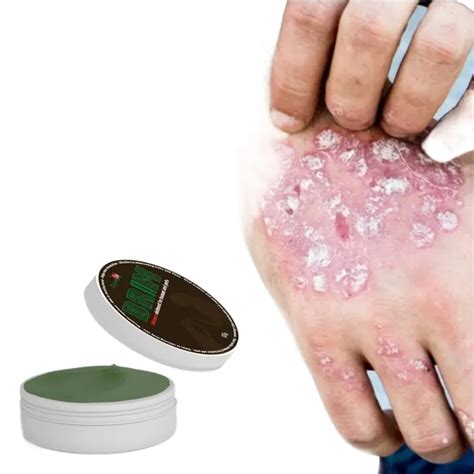 【Spot goods】 BRIM Scabies Ointment scabies treatment for human scabies ...