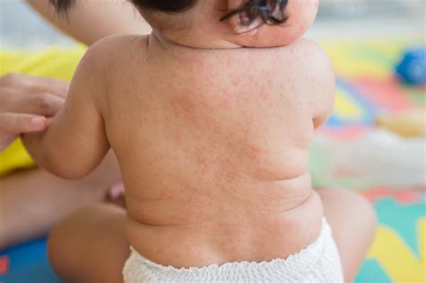 O Que É Roseola Infantil