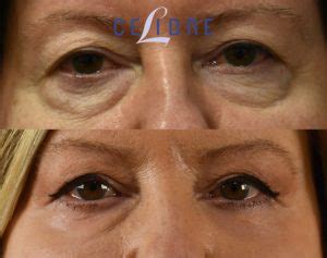 laser resurfacing    pictures  actual patients