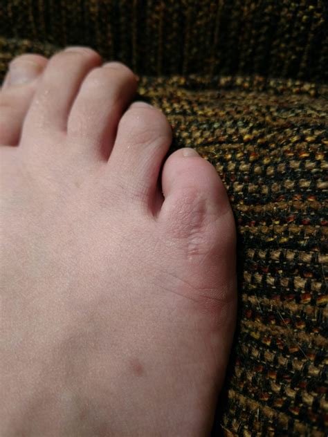 Had my toes shortened in an effort to straighten them out because they