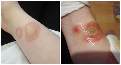 Deodorant Burns Treatment at Melissa Trexler blog
