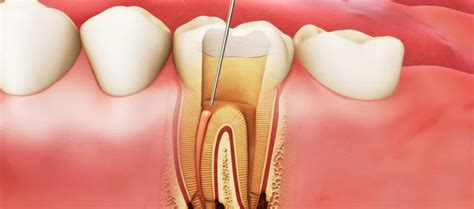 tooth pulpitis symptoms  treatment