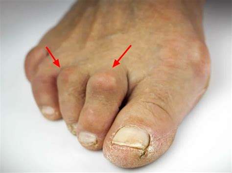 Types Of Toe Problems at Sophie Calvin blog