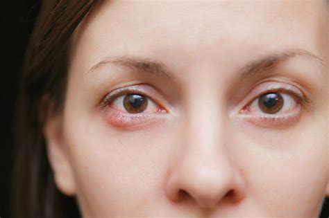 Stye Symptoms, Causes & Treatment [Definitive Guide]