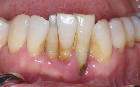 Lower anterior teeth implantation