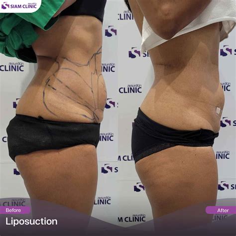 Liposuction Before and After Photos - Siam Clinic Thailand