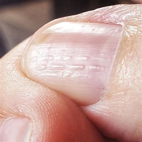 My thumb nail has ridges. : r/mildlyinteresting