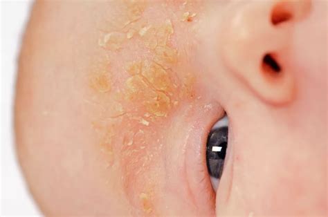What is Seborrheic Dermatitis? - Dr. Eddie's Happy Cappy