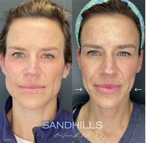 masseter slimming  botox sandhills oral facial surgery