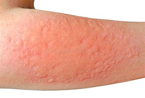 Allergic Vasculitis Rash