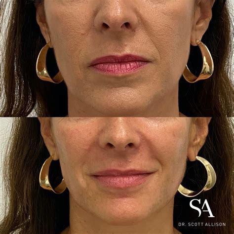 nasolabial fold filler brisbane dr scott allison