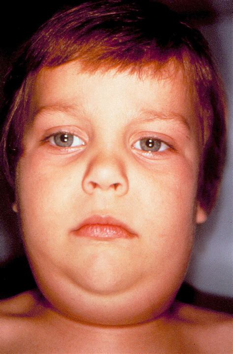 Mumps Images | Immunize.org