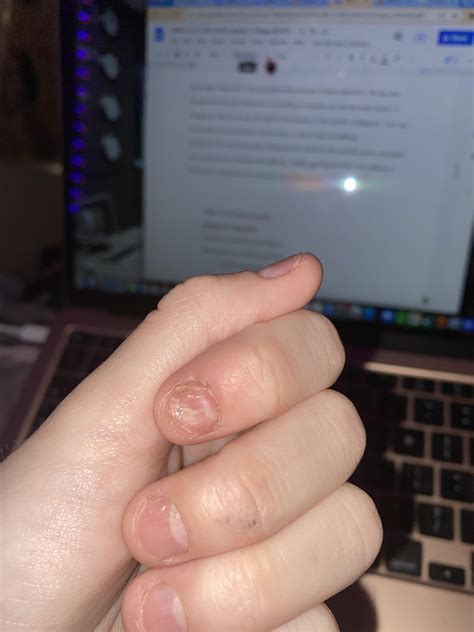 2 years ago an acrylic nail ripped off my real nail on accident