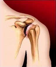 Shoulder Arthritis Treatment, Arthritis Herbal Treatment - Aastha Arthroscopy & Joint Surgeon ...