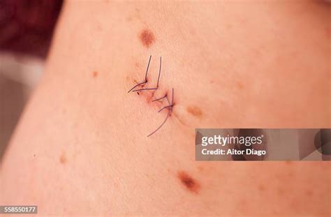 379 Wound Infection Stock Photos, High-Res Pictures, and Images - Getty ...