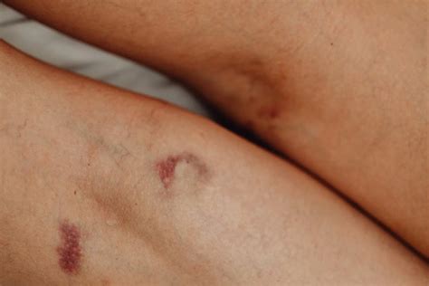 advice  bruising dermatologist tips products dermastore