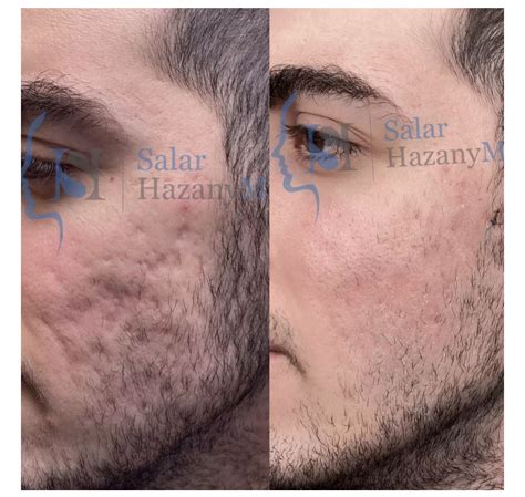 beforeafter excellent results  scar healing institute beverly