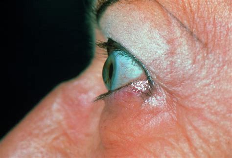 Bulging Eye In Elderly Woman With Graves' Disease Photograph by Science ...