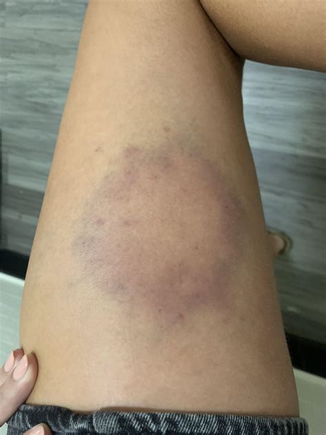 Can someone identify this bite/bruise? My leg was itching a lot last