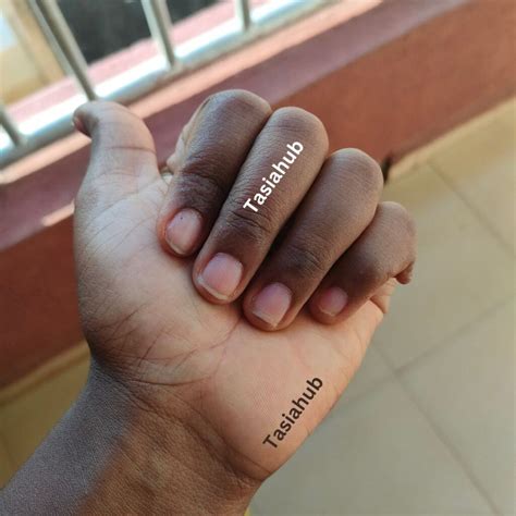 understanding onycholysis   nail  symptoms  treatment