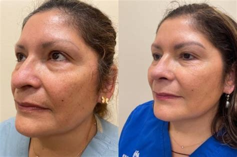 Nose Surgery Before & After Photos Patient 329 | San Francisco, CA ...