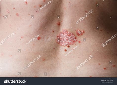 view woman dermatitis problem rash stock photo