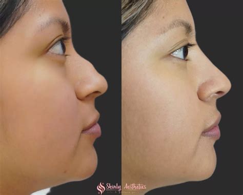 Non-Surgical Rhinoplasty - Before and After Results