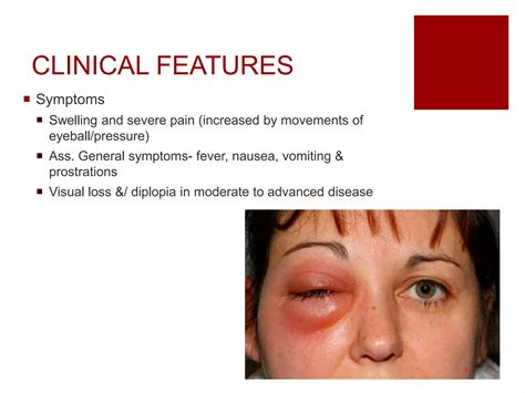 orbital cellulitis pptx